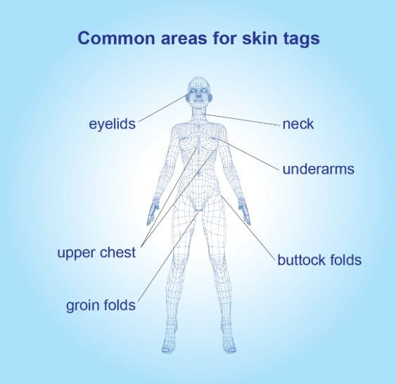 Ihotappien tavalliset esiintymispaikat